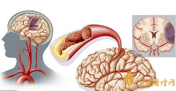 吸烟与中风的关系 长期吸烟将增加中老年人中风风险