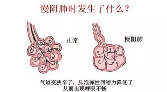 慢性阻塞性肺病（COPD）最后被“憋死” 主因是吸烟